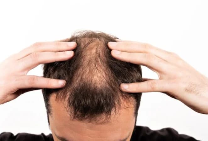 Alopecia: por qué se cae el cabello y qué tratamientos sí funcionan actualmente