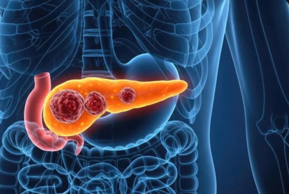 FDA aprueba fármaco contra cáncer de páncreas metastásico, uno de los más mortales