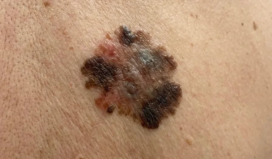 Una nueva vacuna frena el cáncer de piel más agresivo: así funciona la vacuna contra el melanoma