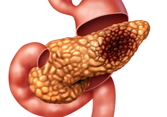 Esquema cáncer de páncreas