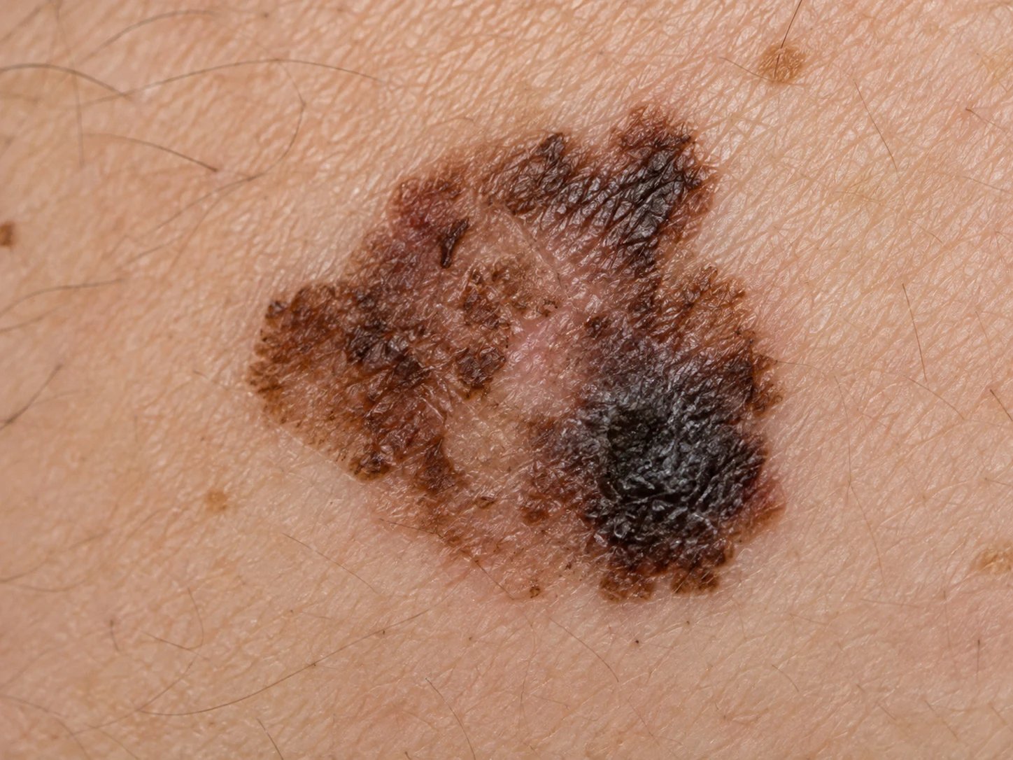 Melanoma en piel.
